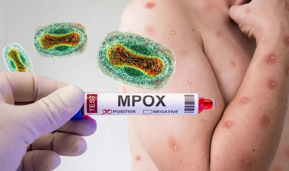 mpox o viruela del mono causa sintoma diagnostico tratamiento