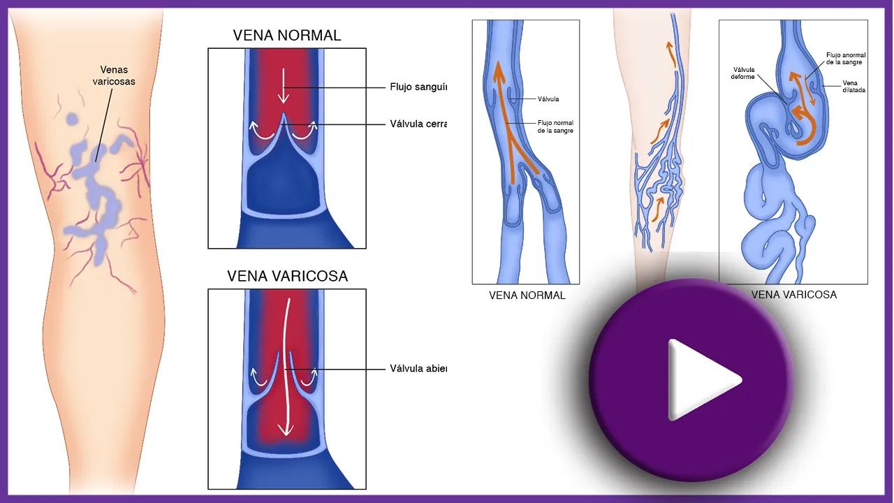 venas