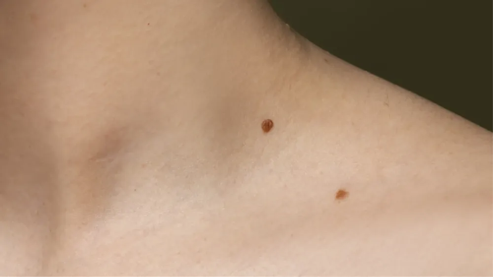 textura-de-piel-de-vista-lateral-con-lunares